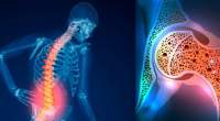 پوکی استخوان در زنان بیشتر از مردان/ توصیه وزارت بهداشت برای کنترل بیماری خاموش