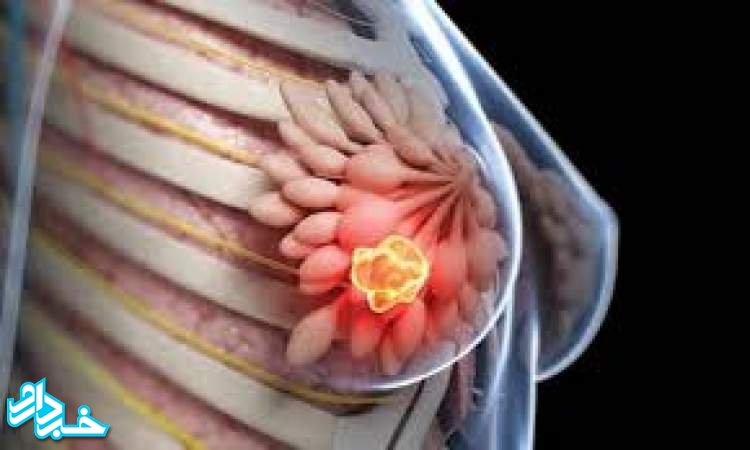 روش  آزمایش بیومارکر HER۲ را برای سرطان سینه و معده آغاز می کند