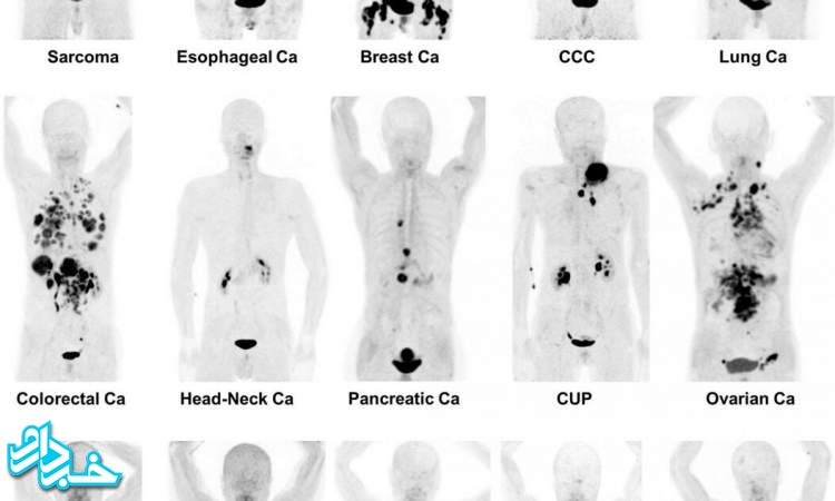 تشخیص ۳۰ نوع سرطان با ردگیر رادیواکتیو جدید