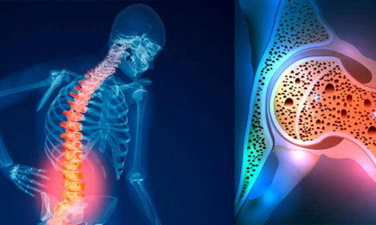 پوکی استخوان در زنان بیشتر از مردان/ توصیه وزارت بهداشت برای کنترل بیماری خاموش