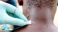 آفریقا برای آبله میمون نه کیت تشخیص دارد نه واکسن